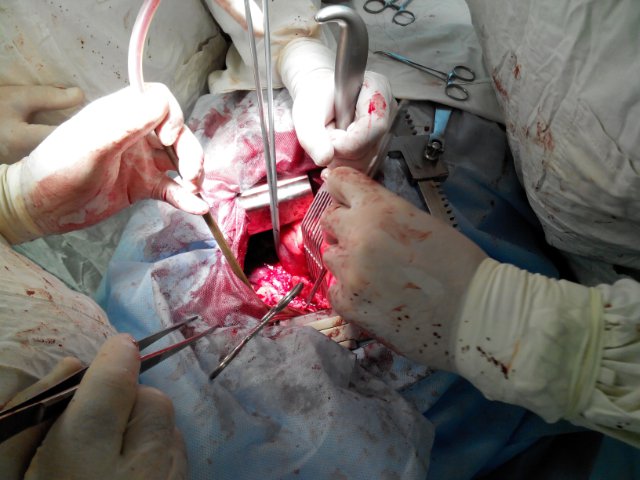 В Бресте прошла уникальная операция по аллотрансплантации легочной артерии - фото